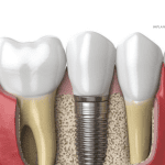 Dental Implant Clinics