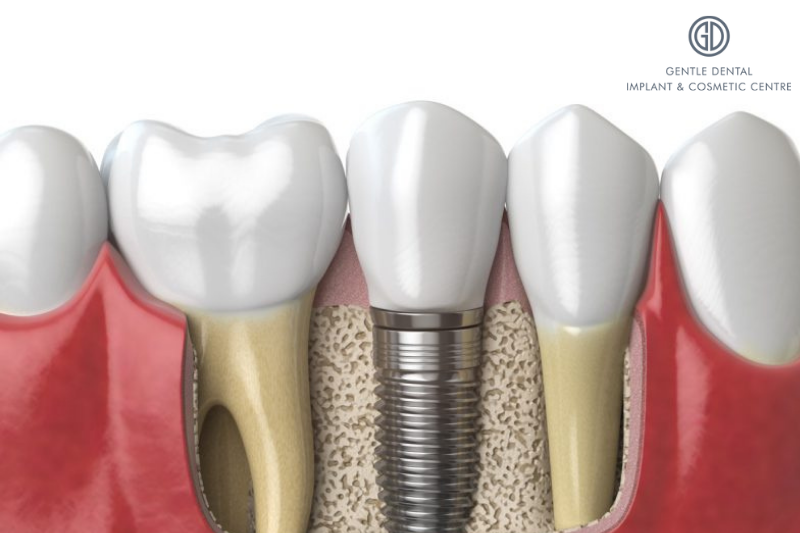 Dental Implant Clinics